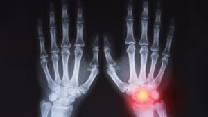 Advantages and Disadvantages of X-Ray